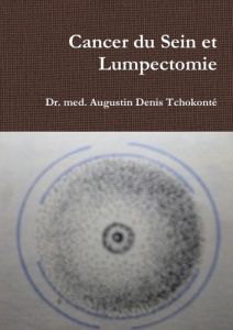 Cancer du Sein et Lumpectomie - Tchokonté Dr. med. augustin denis